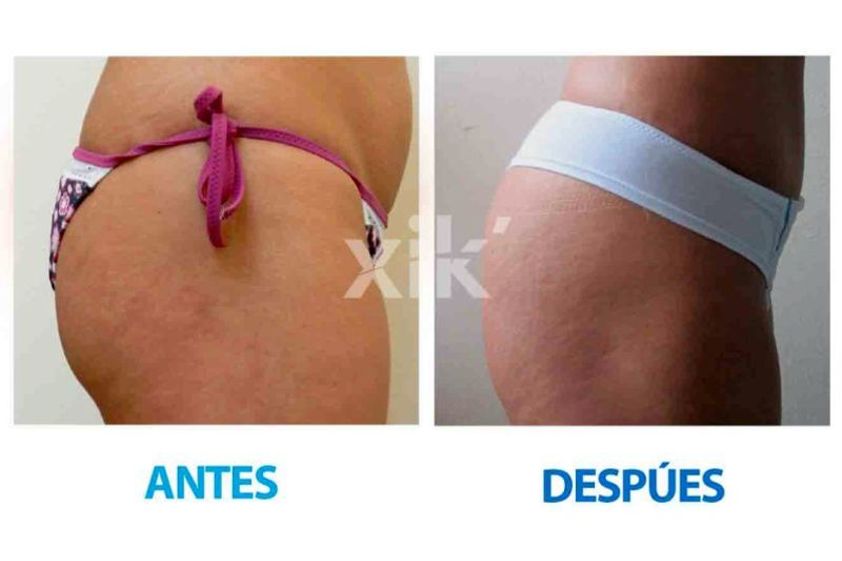 Eliminación estrías antes y después - 635995