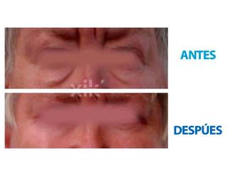 Antes y después de Cirugía de párpados