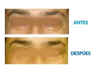 Antes y después de Cirugía de párpados