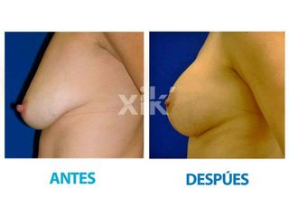 Antes y después de Levantamiento de mamas