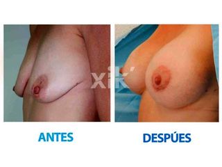 Antes y después de Levantamiento de mamas