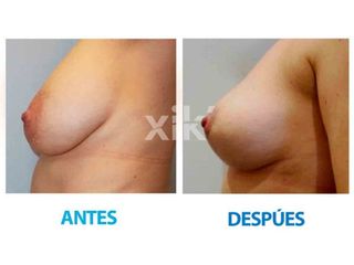 Antes y después de Levantamiento de mamas