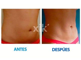 Antes y después de Lipoescultura
