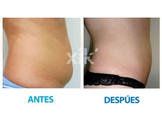 Antes y después de Lipoescultura