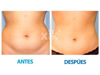 Antes y después de Lipoescultura