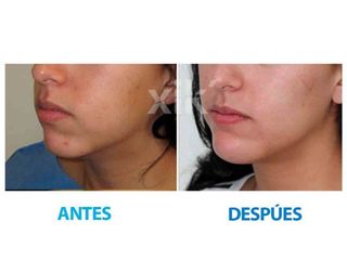 Antes y después de Mentoplastía