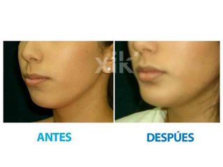 Antes y después de Mentoplastía