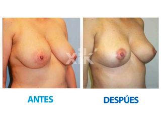 Antes y después de Reducción mamaria