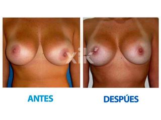 Antes y después de Reducción mamaria