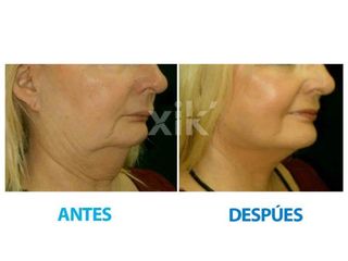 Antes y después de Rejuvenecimiento facial