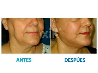 Antes y después de Rejuvenecimiento facial