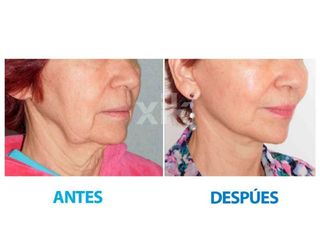 Antes y después de Rejuvenecimiento facial