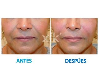 Antes y después de Rellenos faciales