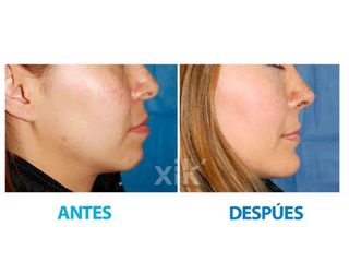 Antes y después de Rinoplastia