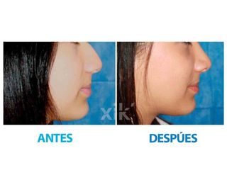 Antes y después de Rinoplastia