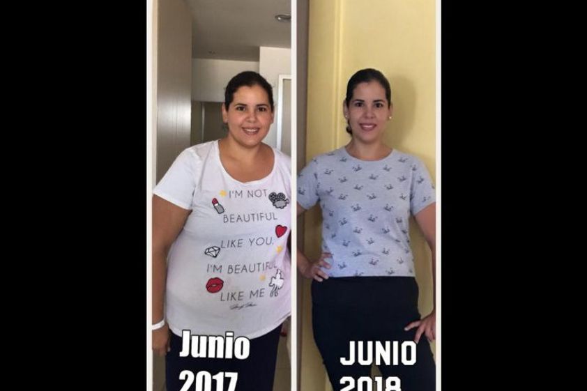 Balón gástrico antes y después - 635528
