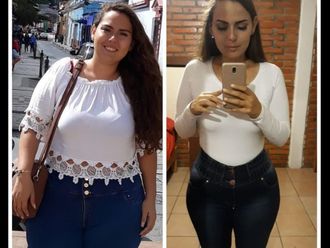 Balón gástrico antes y después - 635530