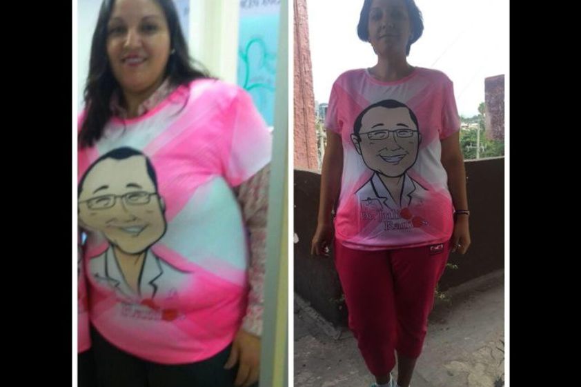 Balón gástrico antes y después - 635536