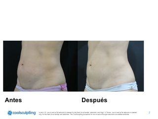 Antes y después de Criolipólisis