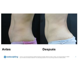 Antes y después de Criolipólisis