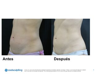 Antes y después de Criolipólisis