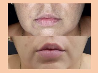 Antes y después de Aumento de labios