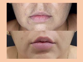 Aumento de labios - Xtabay