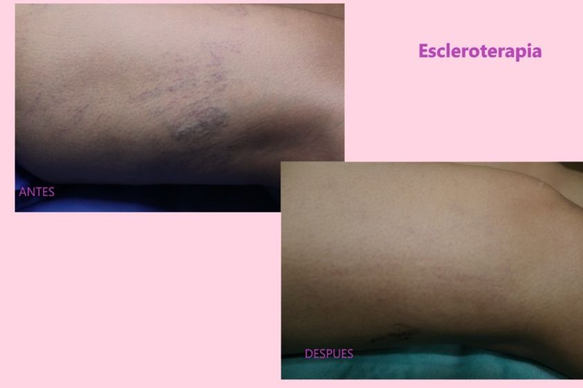 Cirugía varices antes y después - 636629
