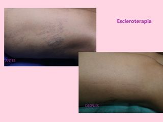 ESCLEROTERAPIA 