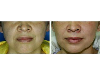 Antes y después de aumento de labios y surco nasogeniano