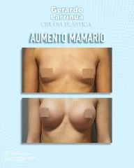 Aumento de busto - Dr. Gerardo Larrinúa Regalado