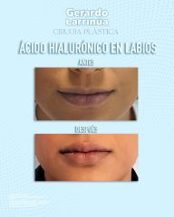 Aumento de labios - Dr. Gerardo Larrinúa Regalado