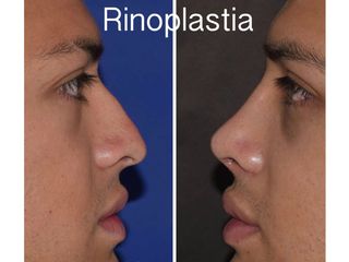 Antes y después de Rinoplastia