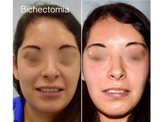 Antes y después de Bichectomia