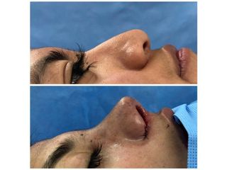 Rinoplastia