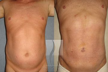 Antes y después de Liposucción