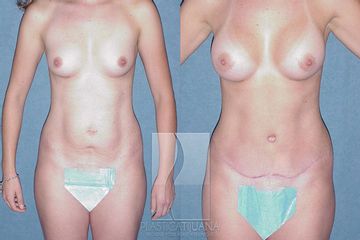 Antes y después de Aumento Mamario / Breast Augmentation