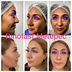 Antes y después de Rinoplastia