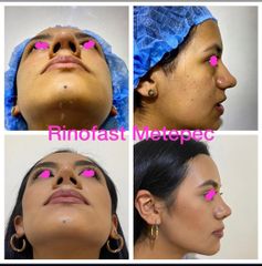 Antes y después de Rinoplastia