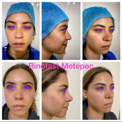 Antes y después de Rinoplastia