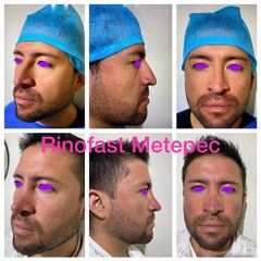 Antes y después de Rinoplastia