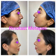 Antes y después de Rinoplastia