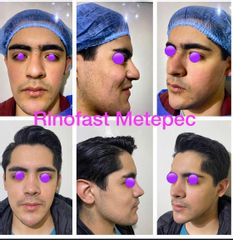 Antes y después de Rinoplastia