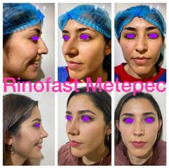 Antes y después de Rinoplastia
