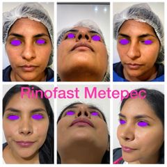 Antes y después de Rinoplastia