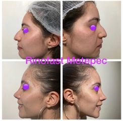 Antes y después de Rinoplastia