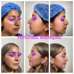Antes y después de Rinoplastia