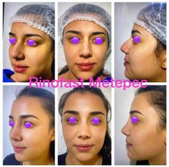Antes y después de Rinoplastia