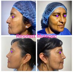 Antes y después de Rinoplastia
