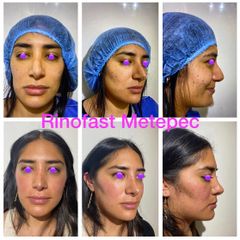 Antes y después de Rinoplastia